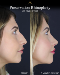 Preservation rhinoplasry, side profile view, before and after