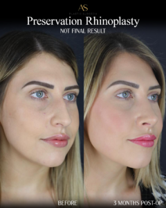 Preservation rhinoplasry, angled profile view, before and after