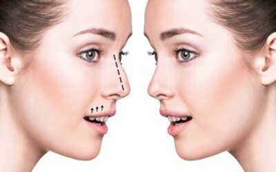 How prepare mentally for a rhinoplasty