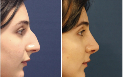 Is a non-surgical rhinoplasty painful?