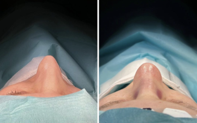 How does your skin affect the the result of rhinoplasty