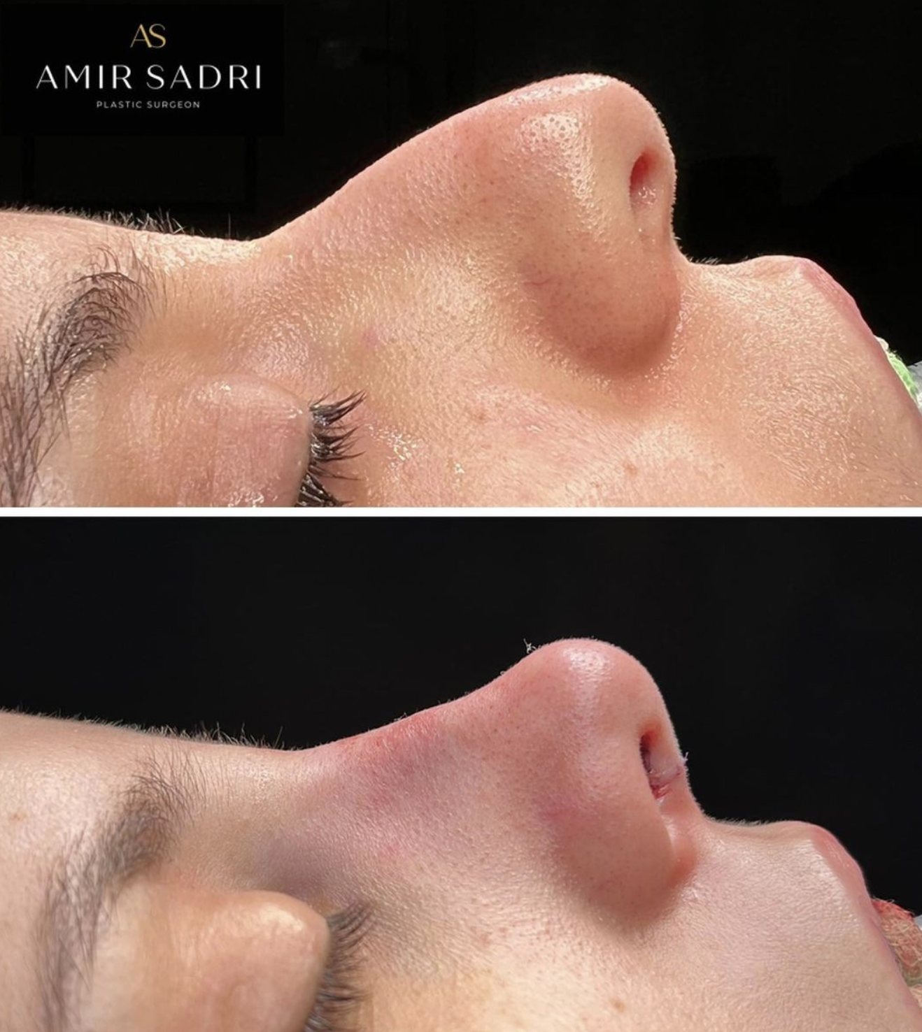 Dorsal Preservation Rhinoplasty. before after