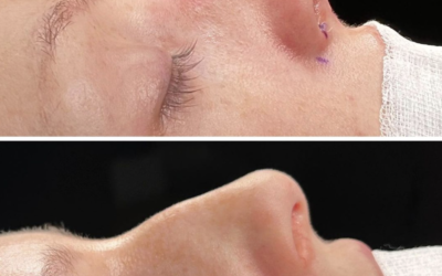 Treatment for a dorsal hump