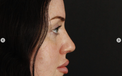 Recovery After Rhinoplasty