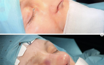 Rhinoplasty Simulation