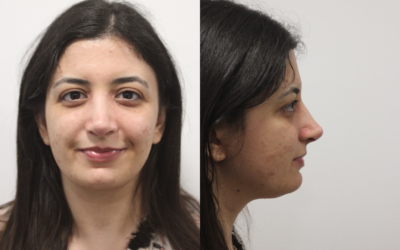 Bruising and swelling after rhinoplasty