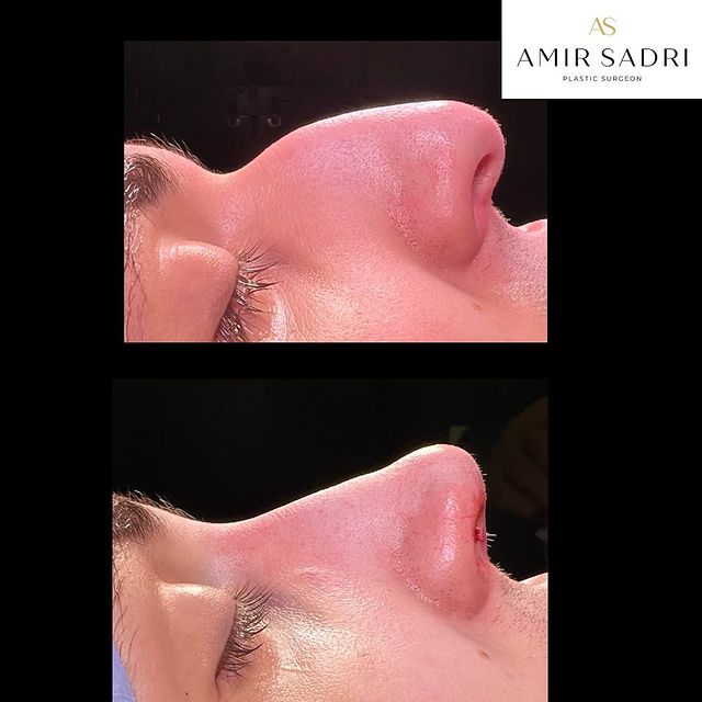 nose job before and after london rhinoplasty before and after london plastic surgeon facial surgeon