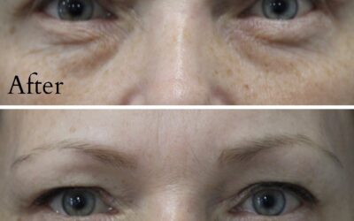 Upper eyelid blepharoplasty