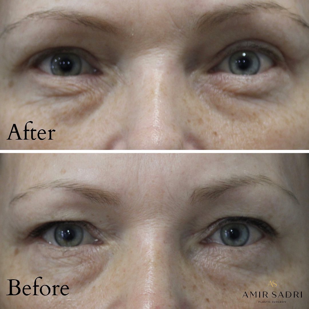 Upper eyelid blepharoplasty before and after london plastic surgeon facial surgeon