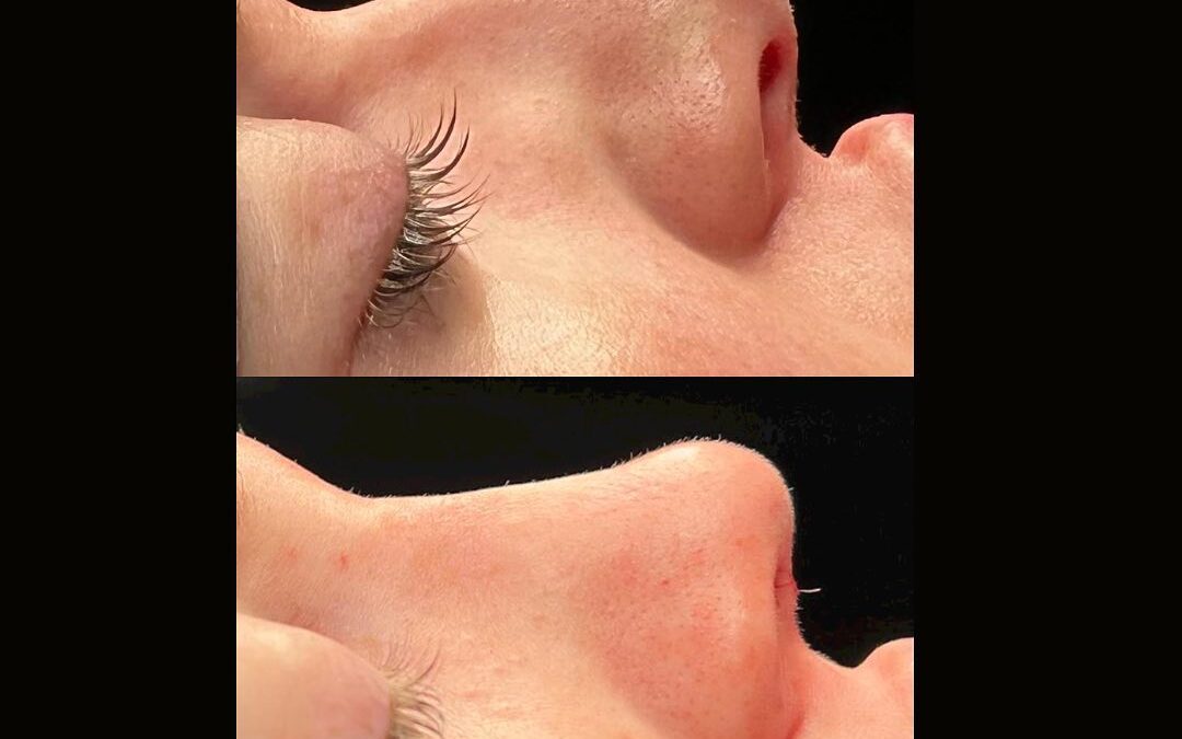 Before/after dorsal preservation rhinoplasty