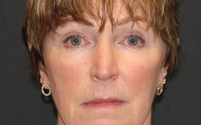 2 Weeks After Face And Neck Lift