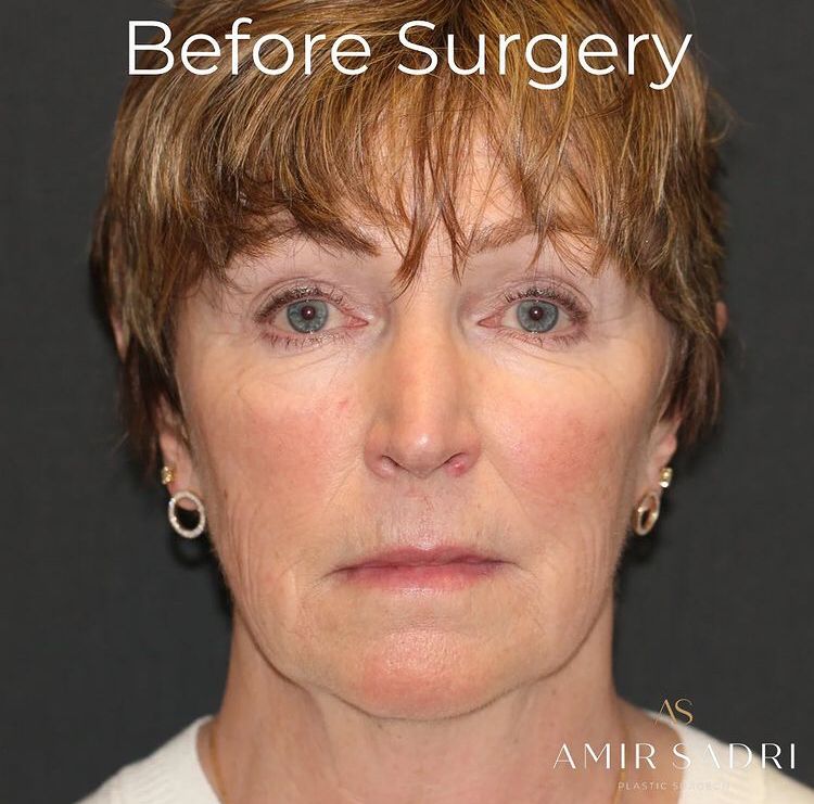 face lift, neck lift, face and neck life before and after london plastic surgeon facial surgeon