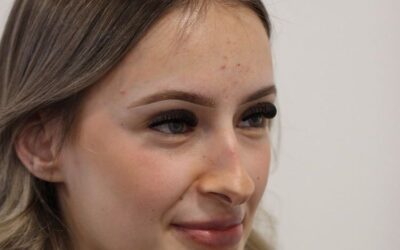 6 Weeks After Dorsal Preservation Rhinoplasty