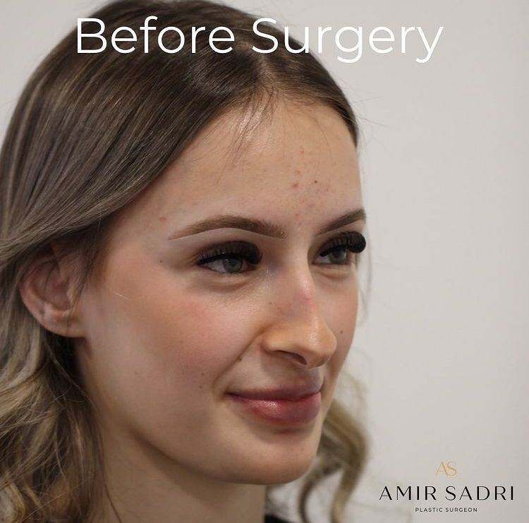nose job rhinoplasty before and after london plastic surgeon facial surgeon