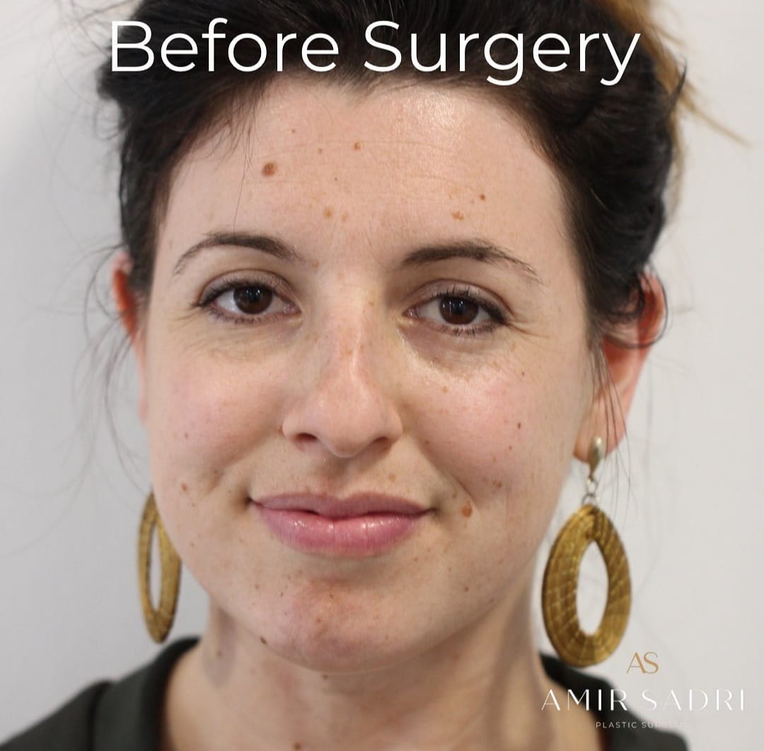 Dorsal preservation rhinoplasty before and after london plastic surgeon facial surgeon