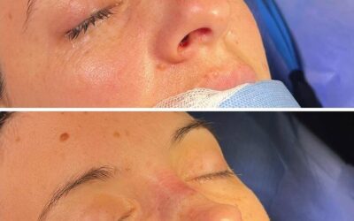 Thick Skin And Rhinoplasty