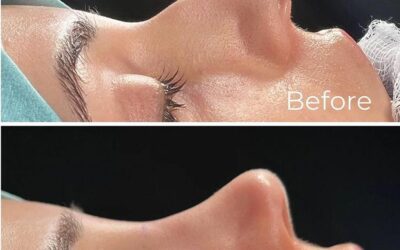 Immediate Result Using Preservation Rhinoplasty Techniques