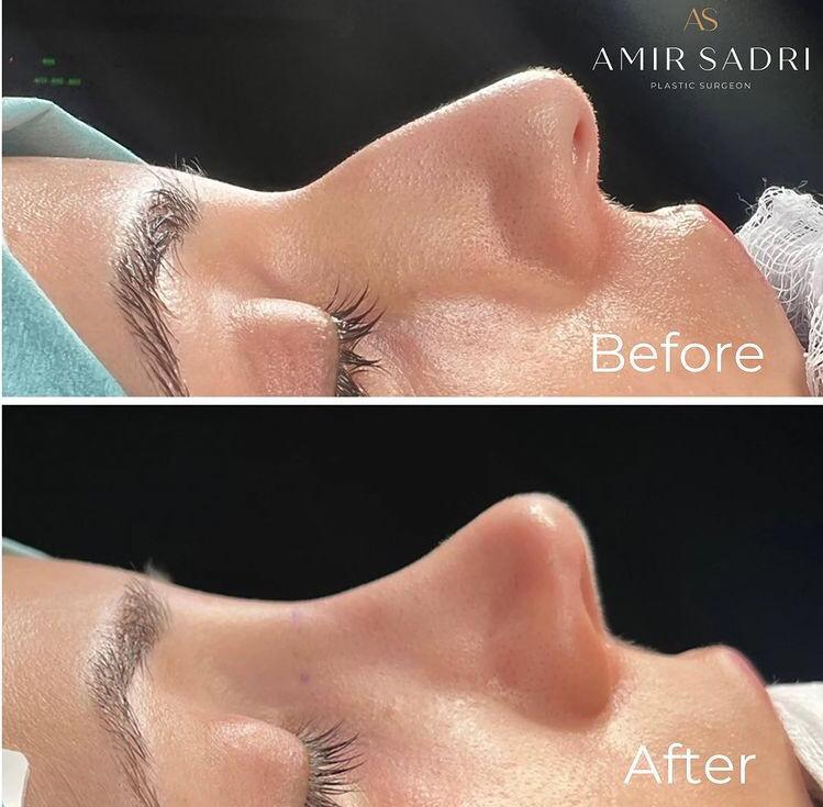 preservation rhinoplasty before and after london plastic surgeon facial surgeon