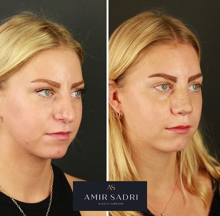before and after rhinoplasty london plastic surgeon facial surgeon