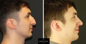 Operative Results Using Structural Rhinoplasty Techniques