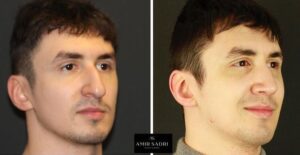 What Happens At 3 Months Post Op Rhinoplasty?