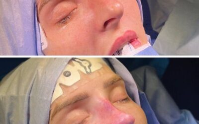 Immediate Results With A High Septal Strip Dorsal Preservation Rhinoplasty