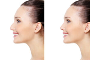 What Can You Not Do After Rhinoplasty?