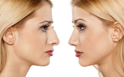 Exploring the Diversity of Nose Cosmetic Surgeries