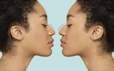 How Long Does Rhinoplasty Swelling Last For?