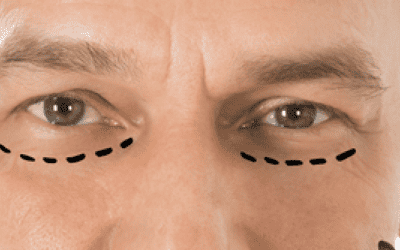 The Top Benefits of Blepharoplasty