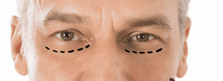 The Top Benefits of Blepharoplasty