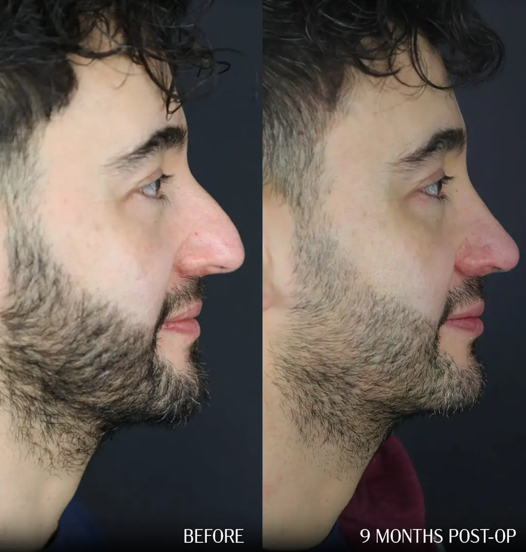 Septorhinoplasty before and after, side profile view, 9 months post-operative.