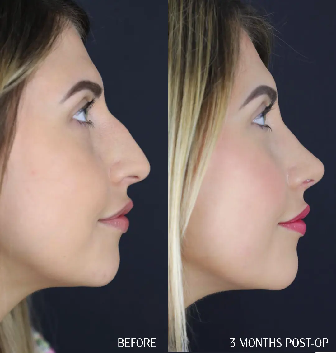 preservation rhinoplasty before and after, side profile, 3 months post-op.