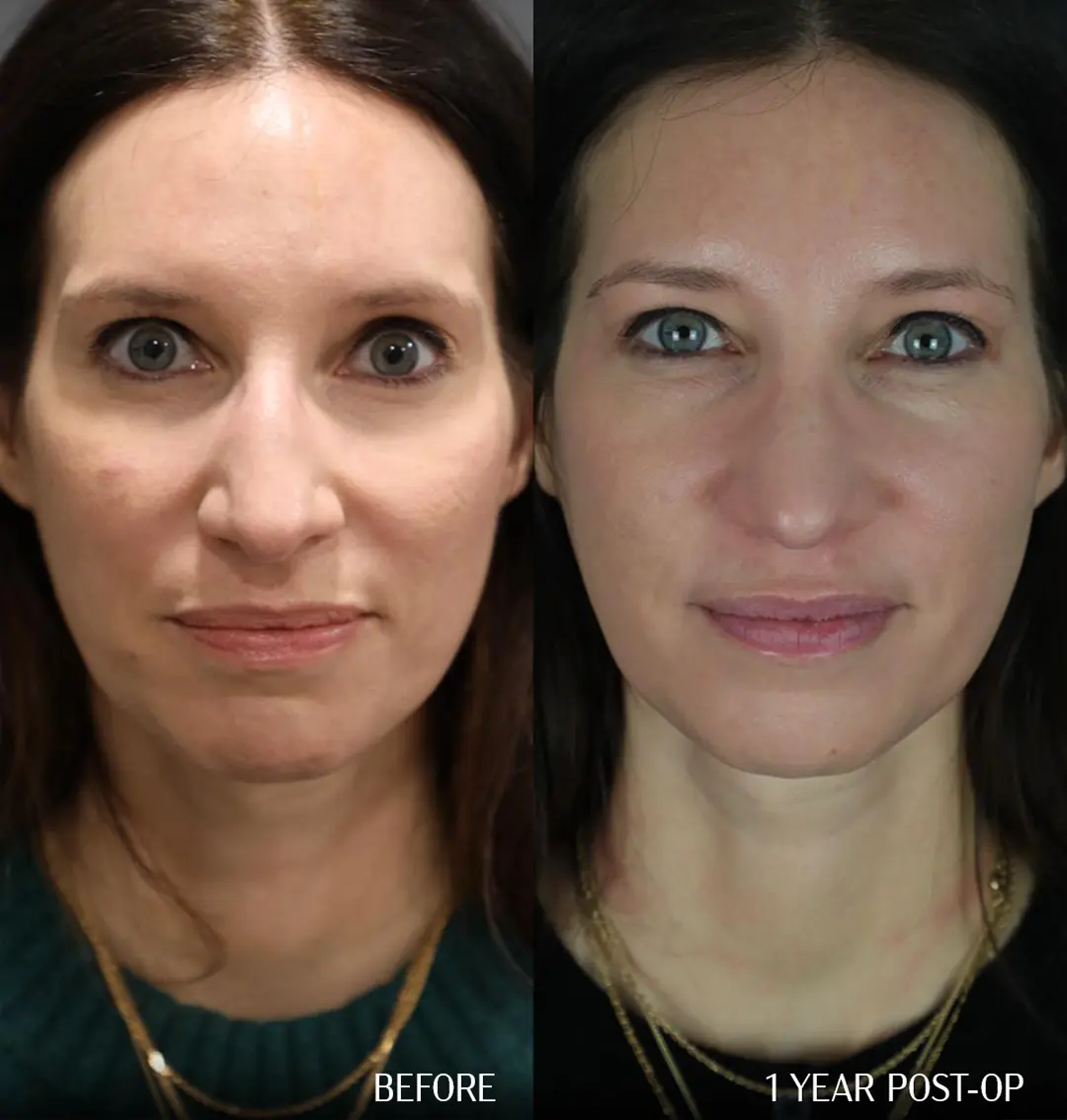 front view dorsal preservation rhinoplasty Before and 1 year after dorsal preservation rhinoplasty, front view comparison.