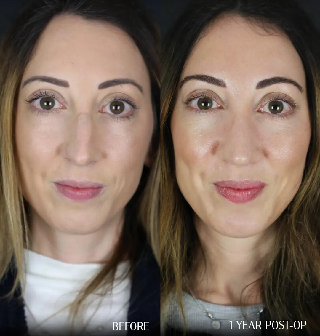 front view septorhinoplasty Before and 1 year after septorhinoplasty, front view comparison.