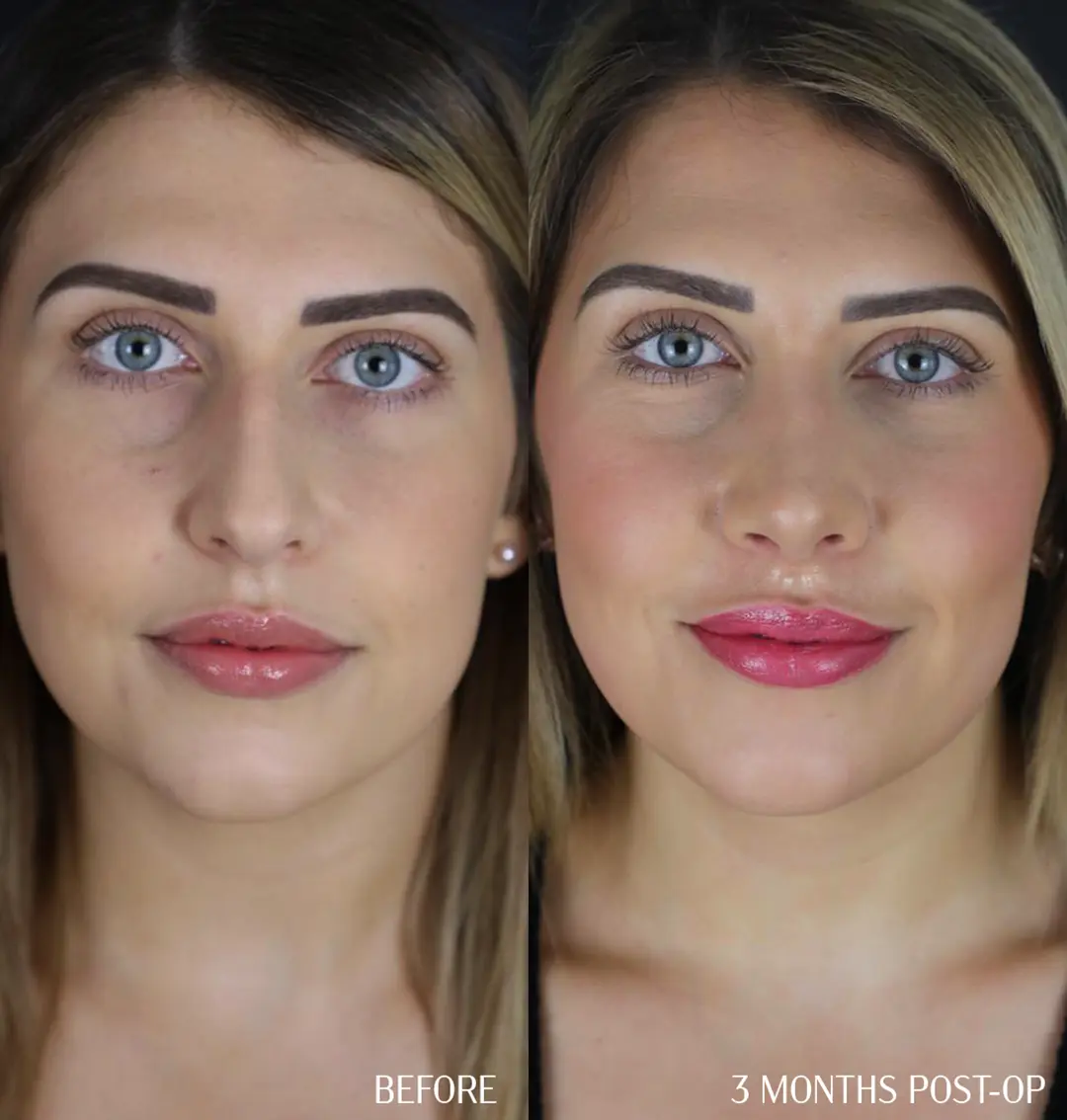front view copy preservation rhinoplasty before and after, front profile, 3 months post-op