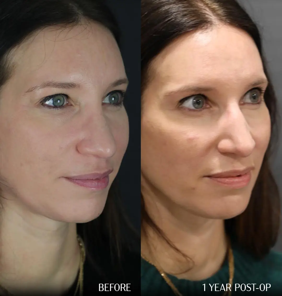 side angle view dorsal preservation rhinoplasty Before and 1 year after dorsal preservation rhinoplasty, three-quarter view comparison.