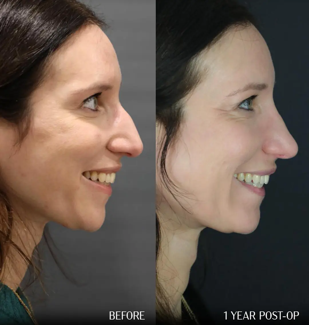 side smile view dorsal preservation rhinoplasty Before and 1 year after dorsal preservation rhinoplasty, side profile smiling comparison.