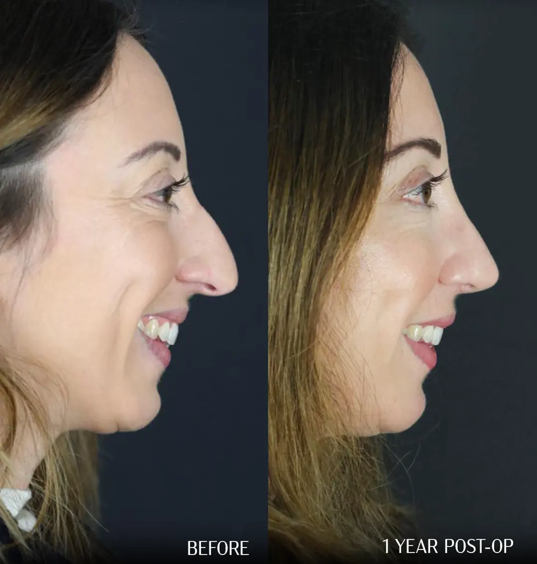 Before and 1 year after septorhinoplasty, side profile smiling comparison.