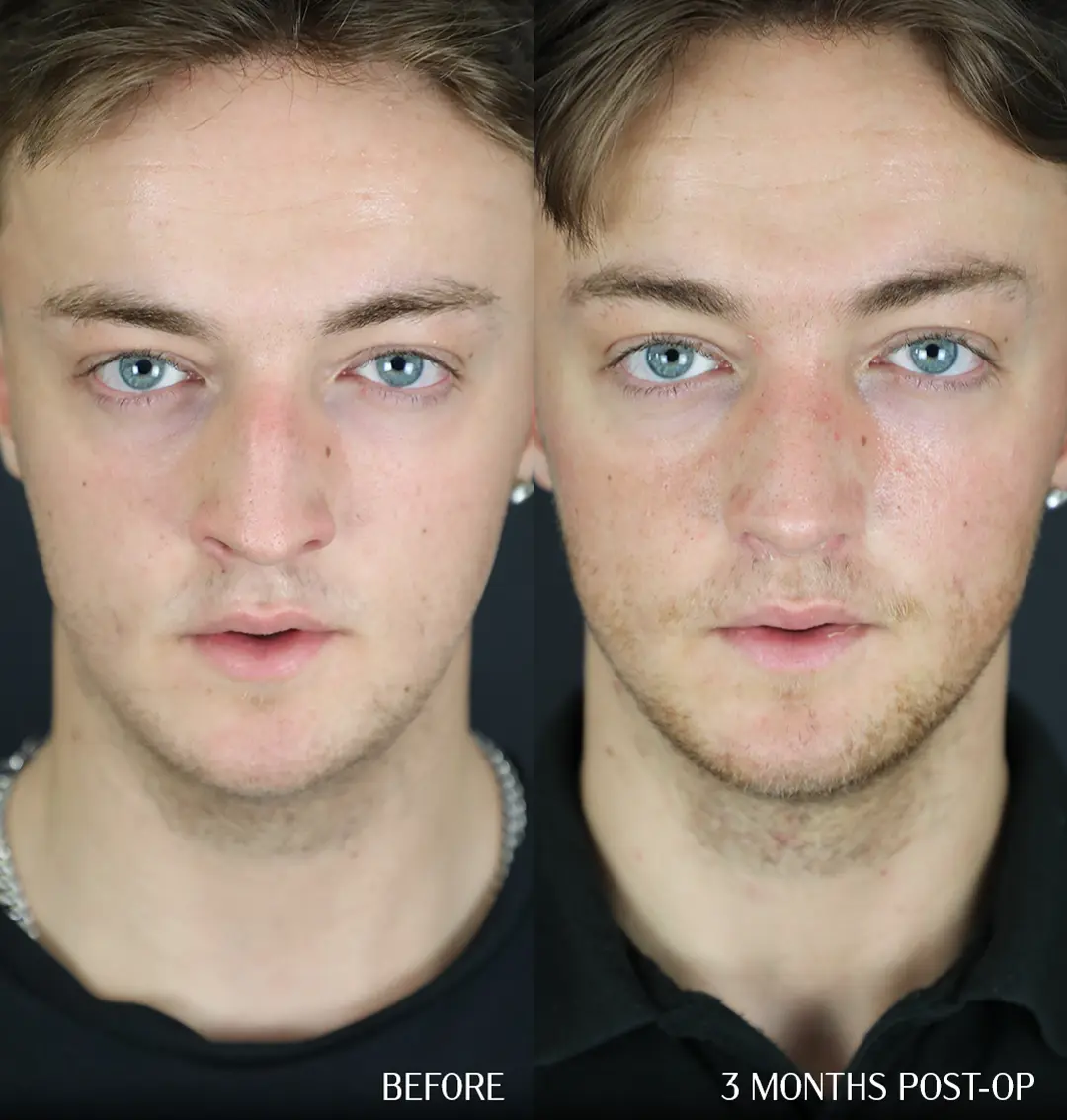 septorhinoplasty before and after 3 months front view septorhinoplasty before and after 3 months front view