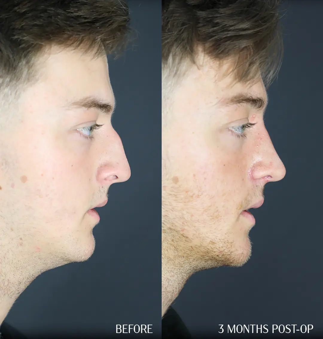 septorhinoplasty before and after 3 months side profile septorhinoplasty before and after 3 months side profile