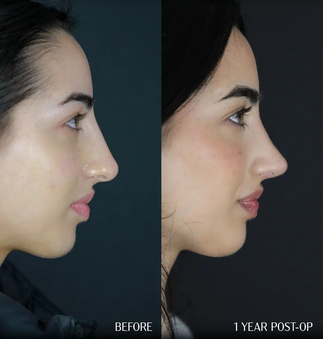 before rhinoplasty and 1 year after rhinoplasty comparison side profile