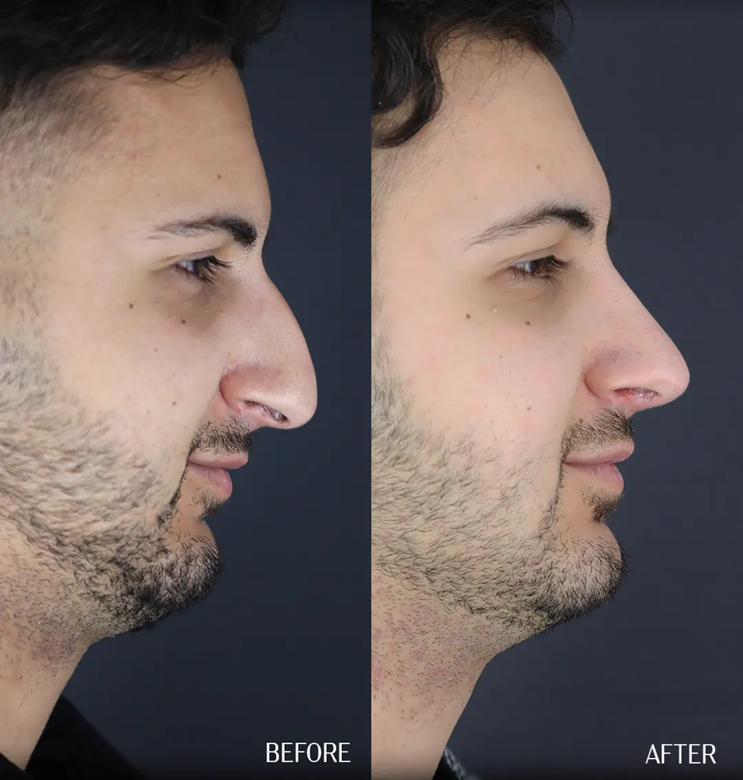 side septorhinoplasty before after male side profile