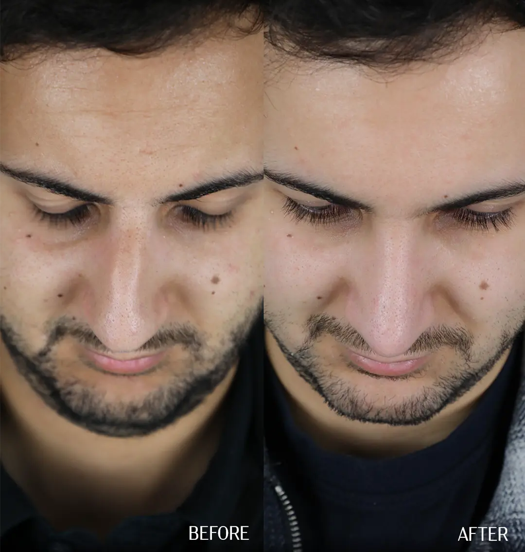 top down septorhinoplasty before after male top down view